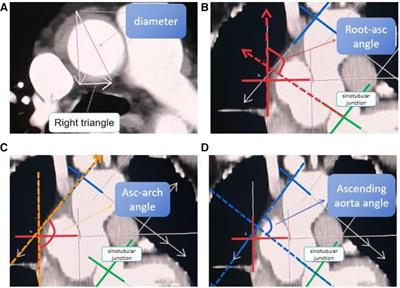 The correlation study between the length and angle of ascending aortic and the incidence risk of acute type A aortic dissection